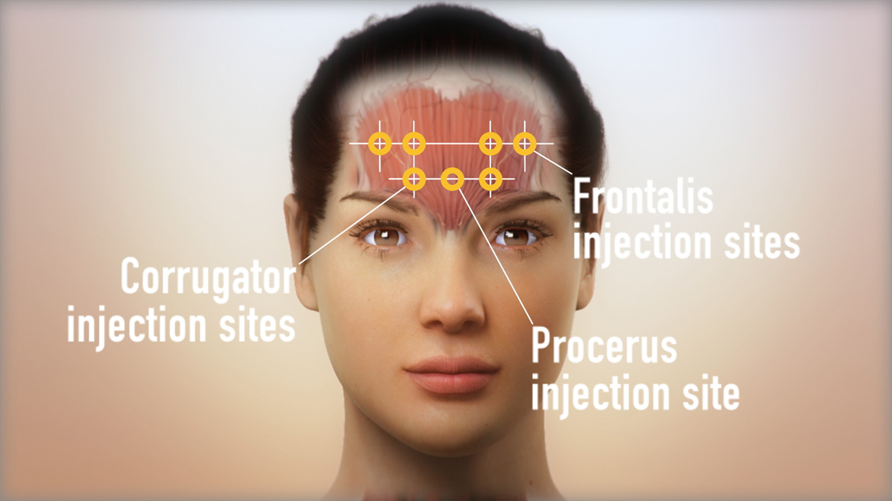 3D anatomical render with injection markers